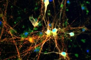 Brain cells (neurons) where two substances are highlighted: tau, appears in red, and glycogen appears in green. Where the two overlap, the color turns yellow or orange.