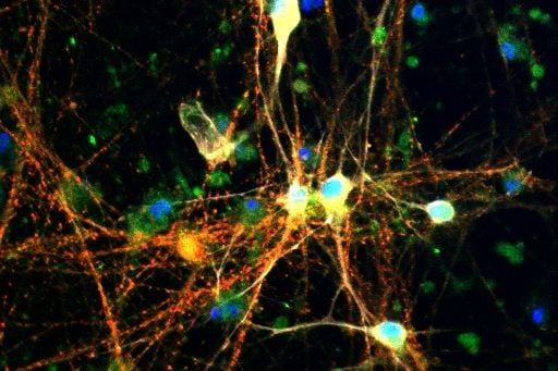 Brain cells (neurons) where two substances are highlighted: tau, appears in red, and glycogen appears in green. Where the two overlap, the color turns yellow or orange.